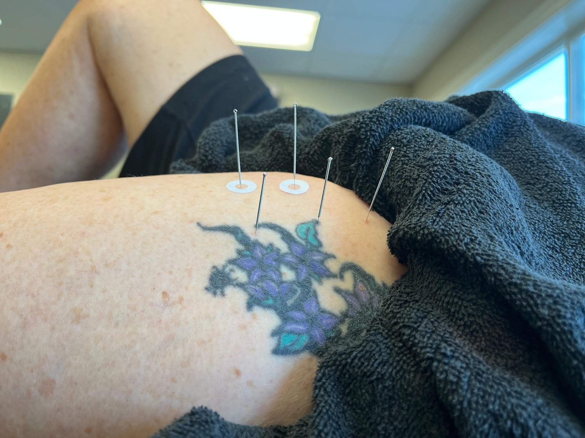 Looking for dry needling physical therapy near me? We can help! Click to this dry needling physical therapy page for more information.