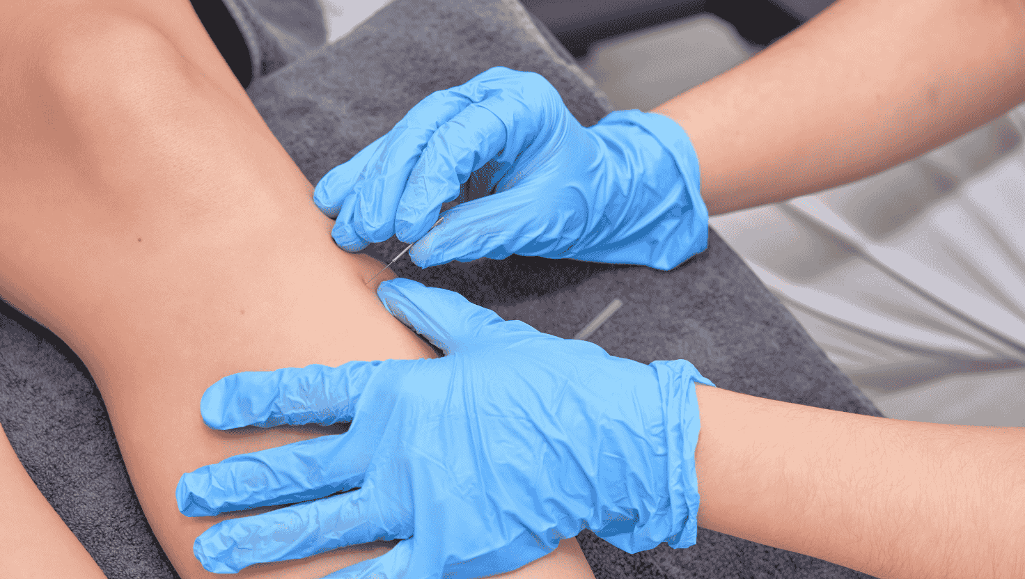 What Does Dry Needling Do? Discover the Benefits and Myths