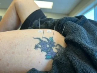 Physical therapy with dry needling.