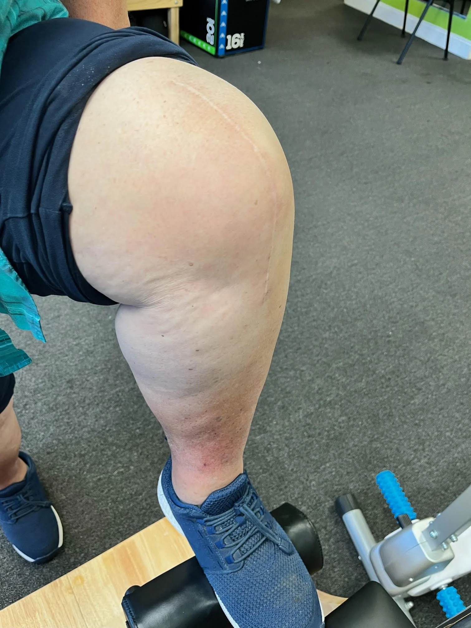 Want to know what to expect when you visit a physical therapist? If you recently had total knee replacement surgery, then expect the following exercises to help your alignment problems.