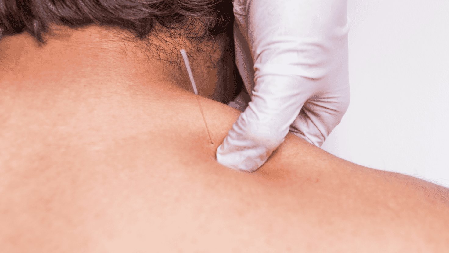 The thing that sets dry needling physical therapy apart from other physical therapy treatments is that it helps with things like knee pain, hip pain, shoulder pain, and more by using thin needles.