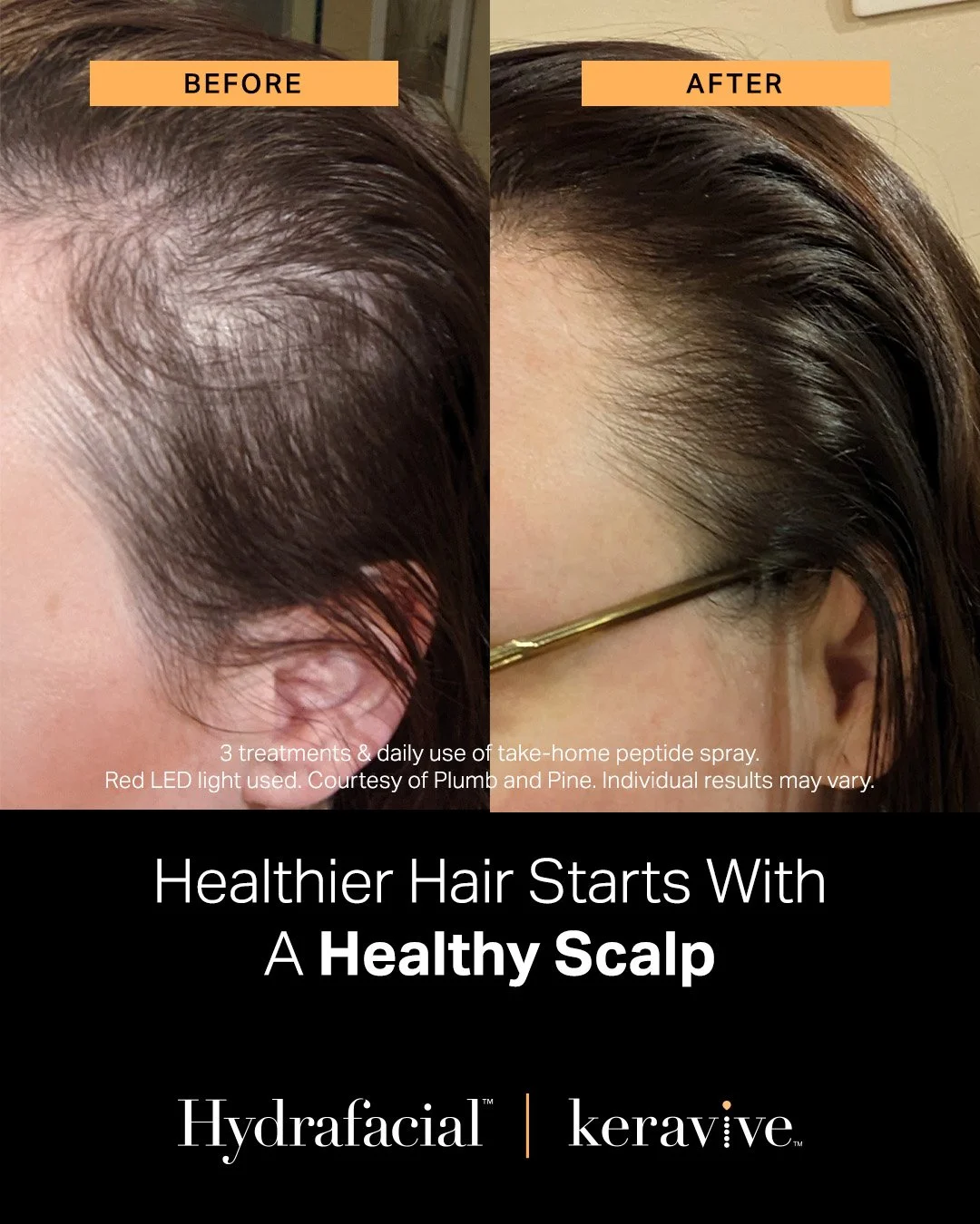 Healthy scalp, healthy hair ✨

Our Keravive HydraFacial is designed to deeply cleanse, exfoliate, and hydrate the scalp&mdash;removing buildup and delivering nutrients right where your hair needs it most. The result? A refreshed scalp and fuller, hea