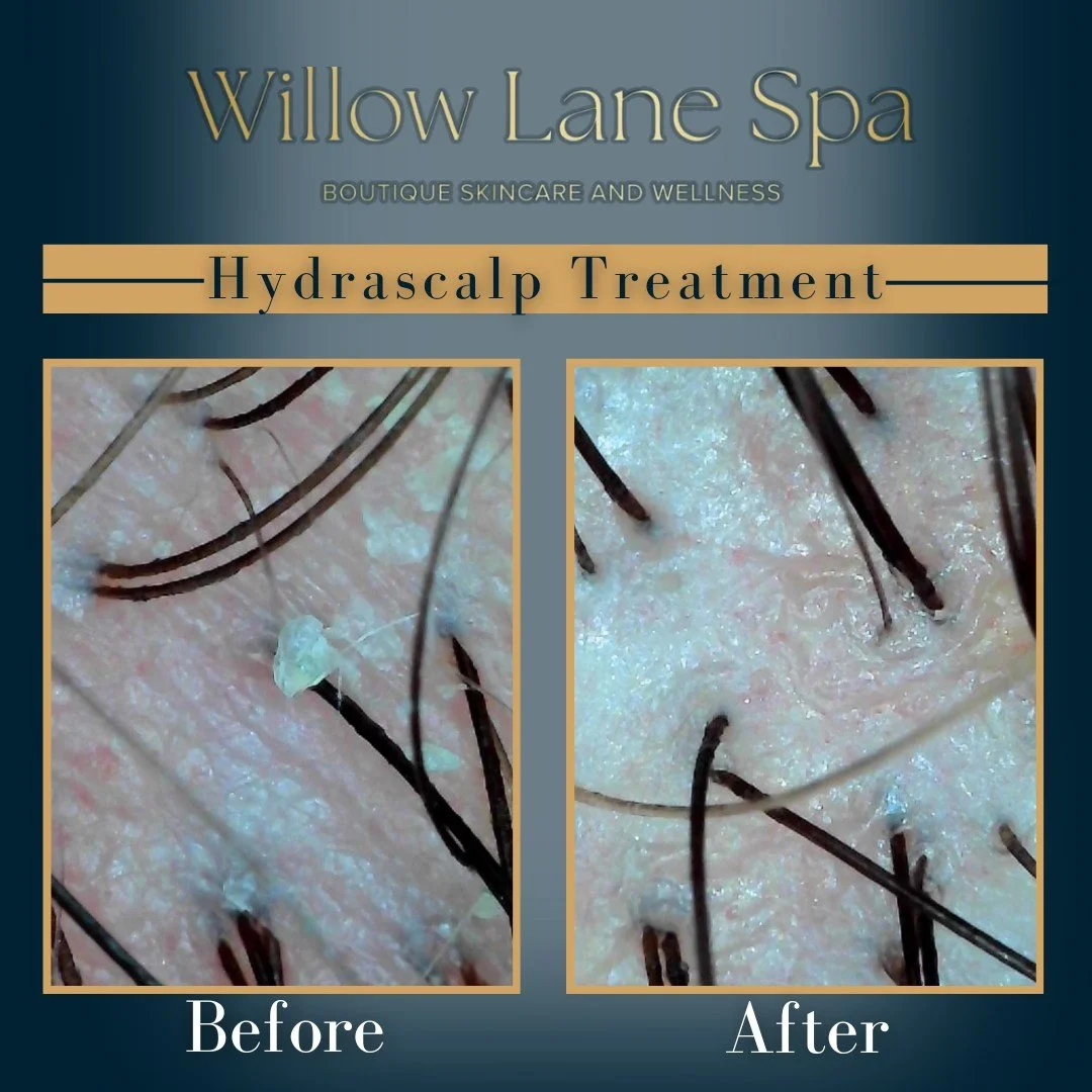 Healthy hair starts at the scalp ✨

A closer look at the difference a Hydrascalp treatment can make 👀

This treatment deeply cleanses, exfoliates, and hydrates the scalp while helping remove buildup, excess oil, and congestion that can affect overal