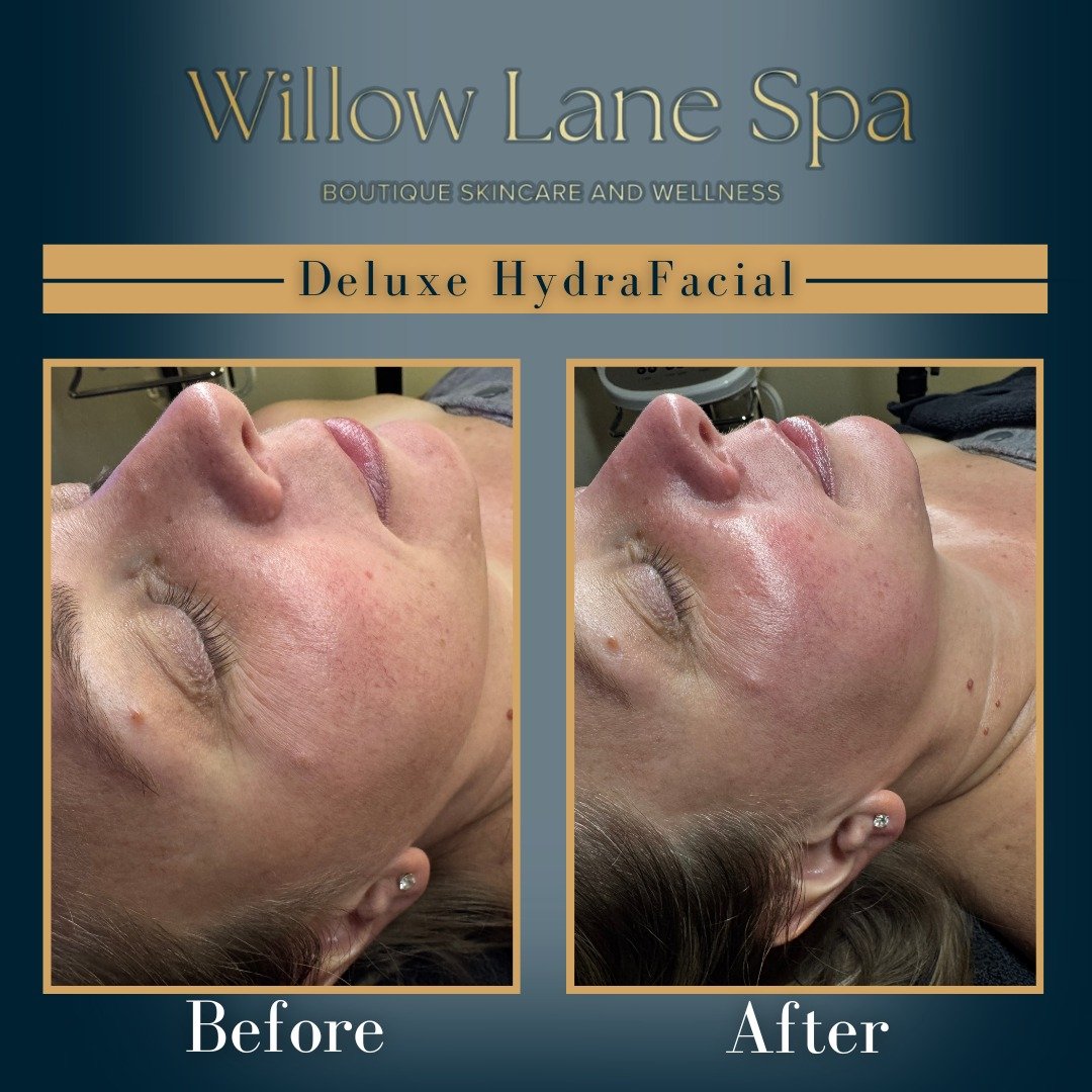 Today&rsquo;s VIP Deluxe Hydrafacial results ✨💧

Brighter skin, smoother texture, deep hydration, and that fresh post-facial glow we&rsquo;re obsessed with. At Willow Lane Spa, our VIP Deluxe Hydrafacial is designed to deeply cleanse, exfoliate, hyd