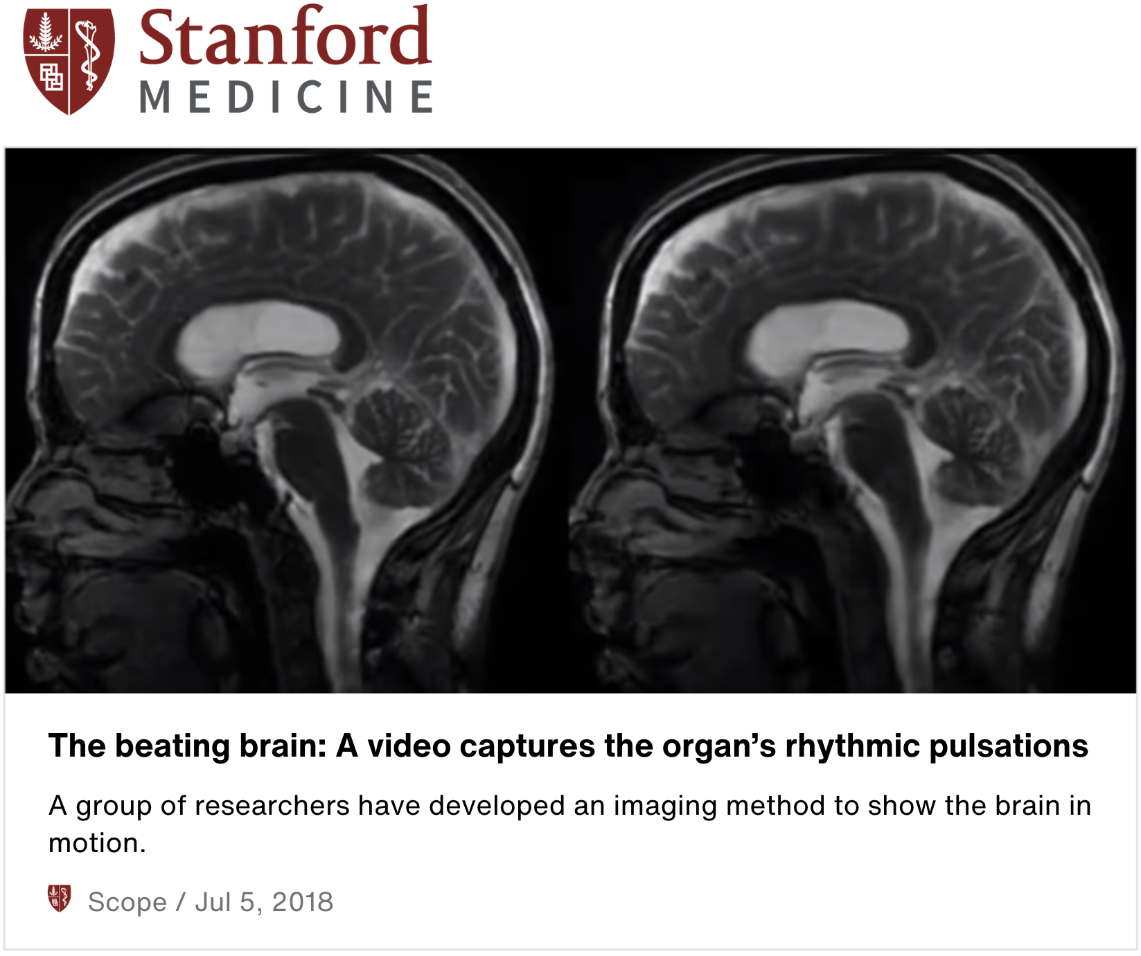 MRI scans of a human brain, showing a side view of the brain's structure.