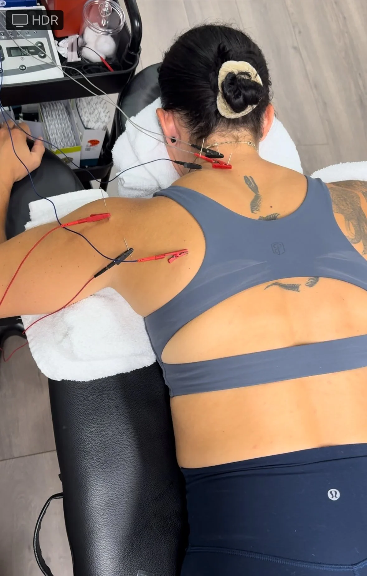 dry needling shoulder pain