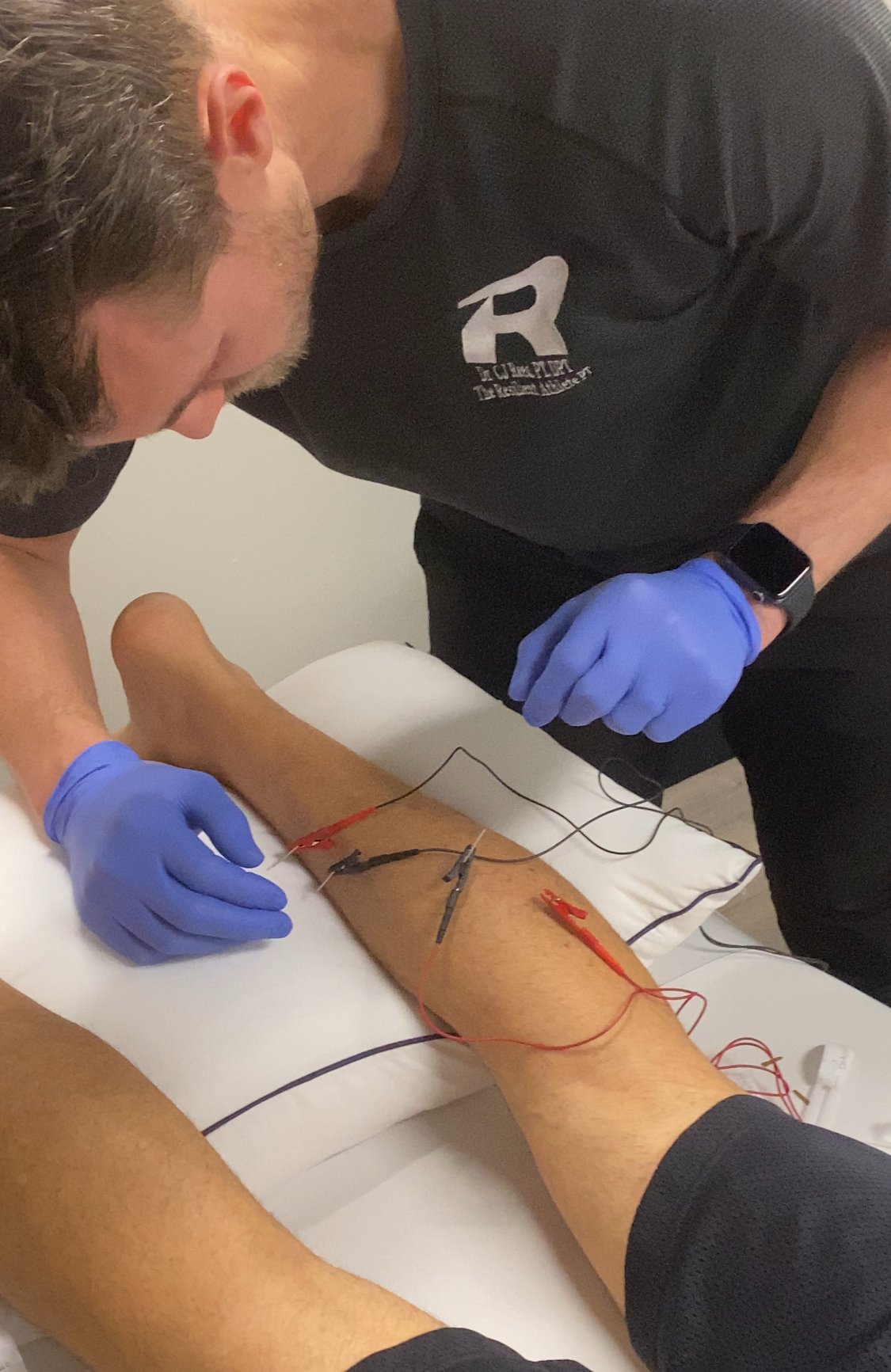 dry needling achilles