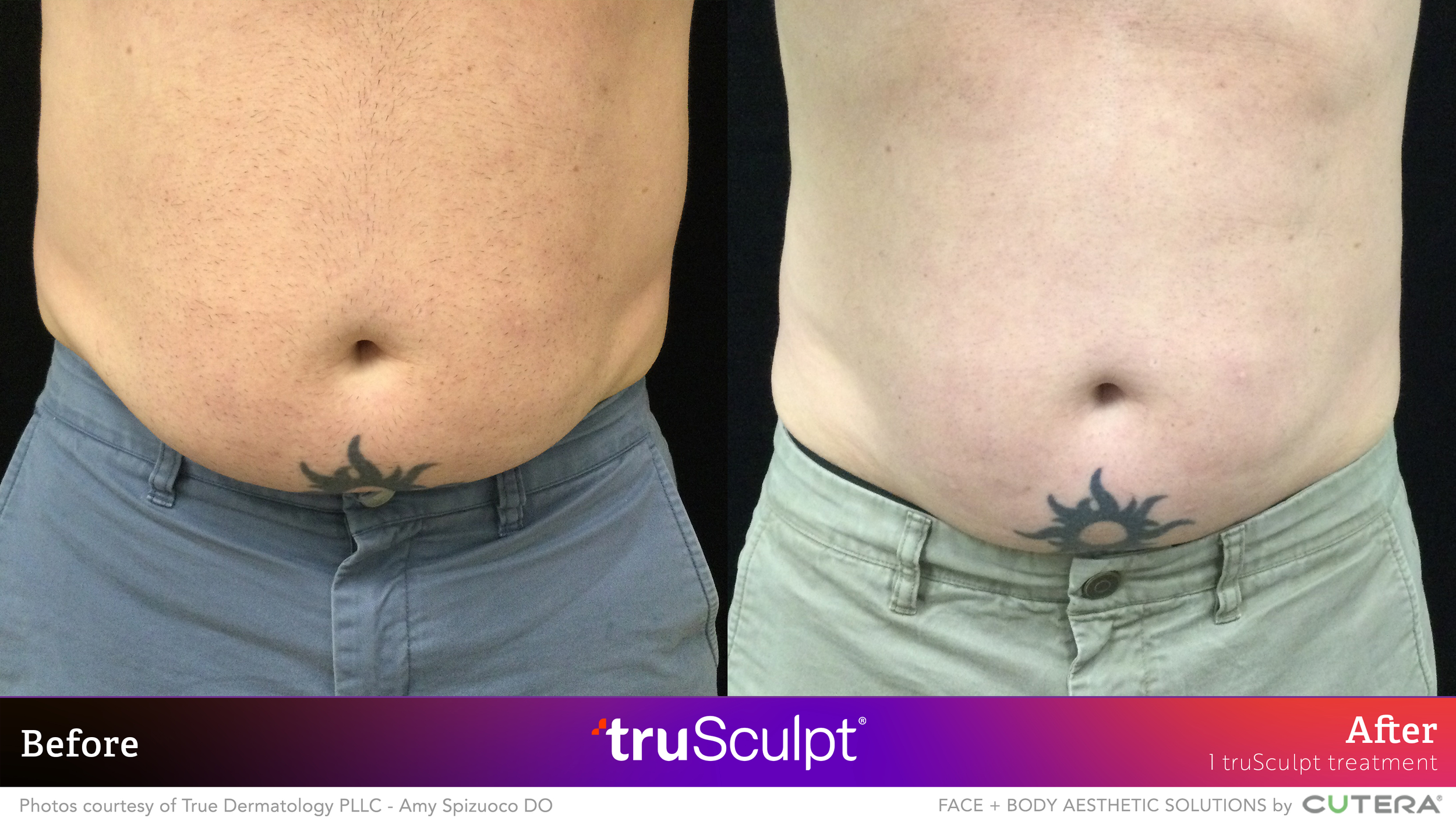 03_truSculpt ID_B&A_True Dermatology.png