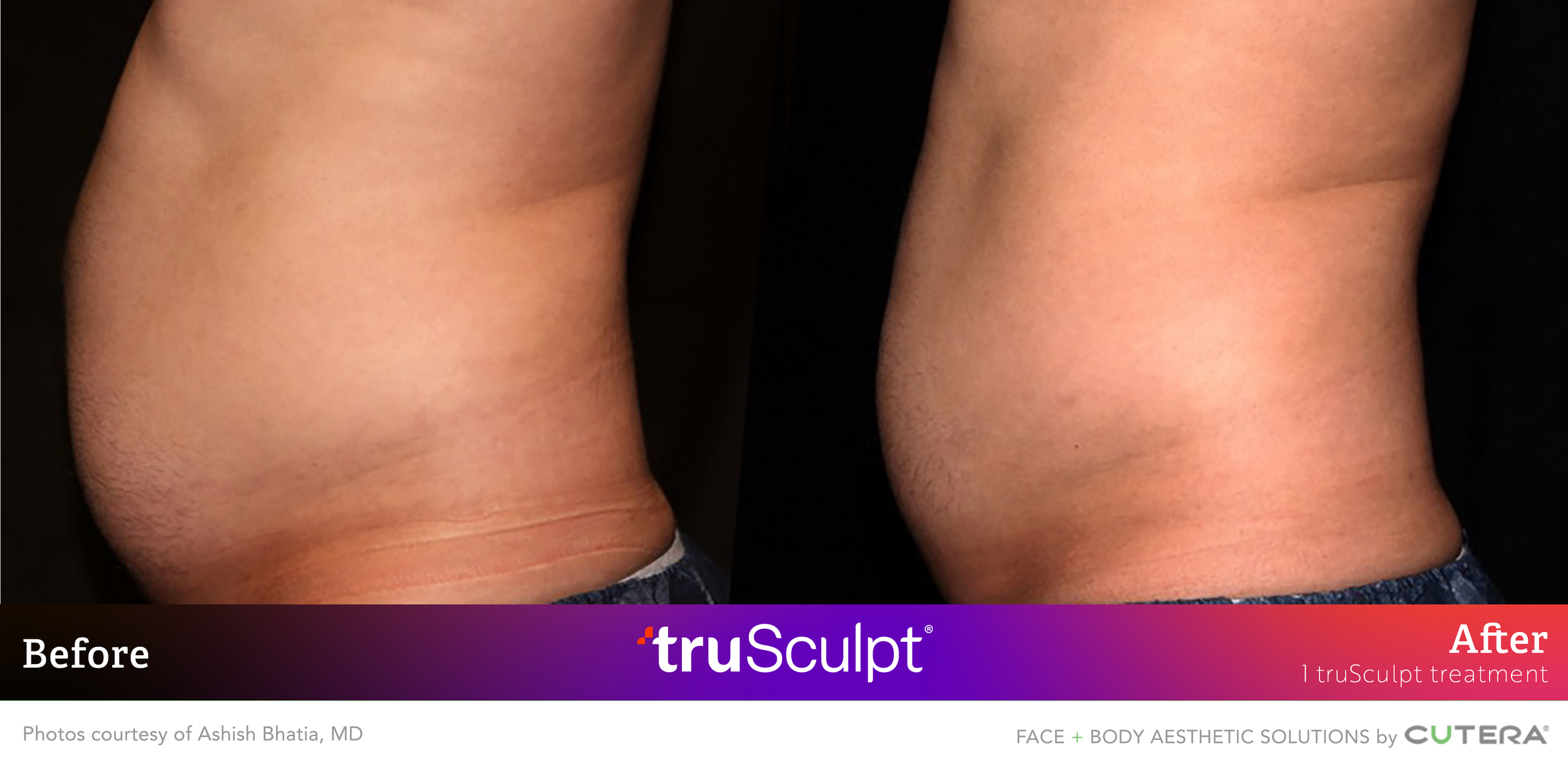 Bhatia 1Tx B&A 2.png