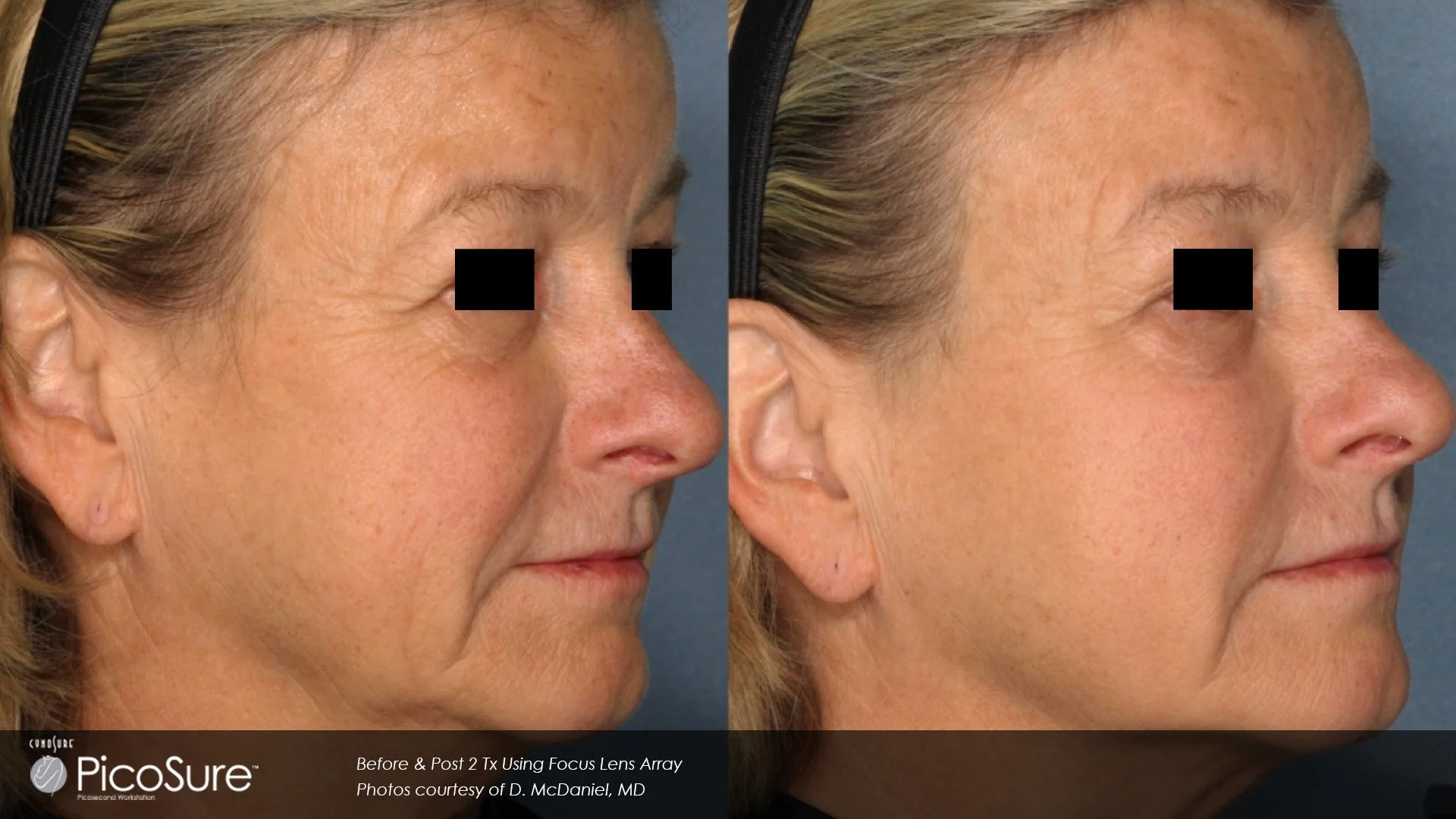 BA_PicoSure_D.-McDaniel_Pigm_Post2Tx.jpg