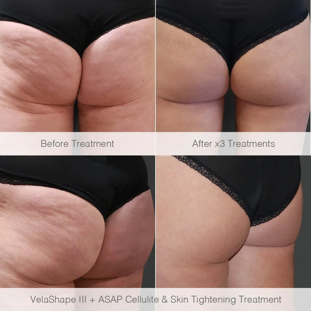 Velashape-cellulite-treatment-perth-cellulite-treatment-cottesloe.jpg