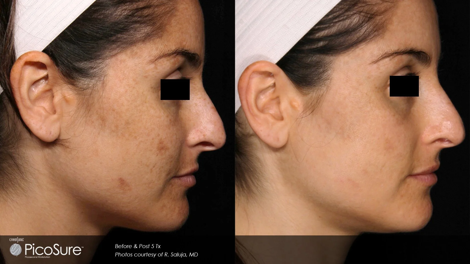 BA_PicoSure_R_Saluja_Pigm_Post5Tx.jpg