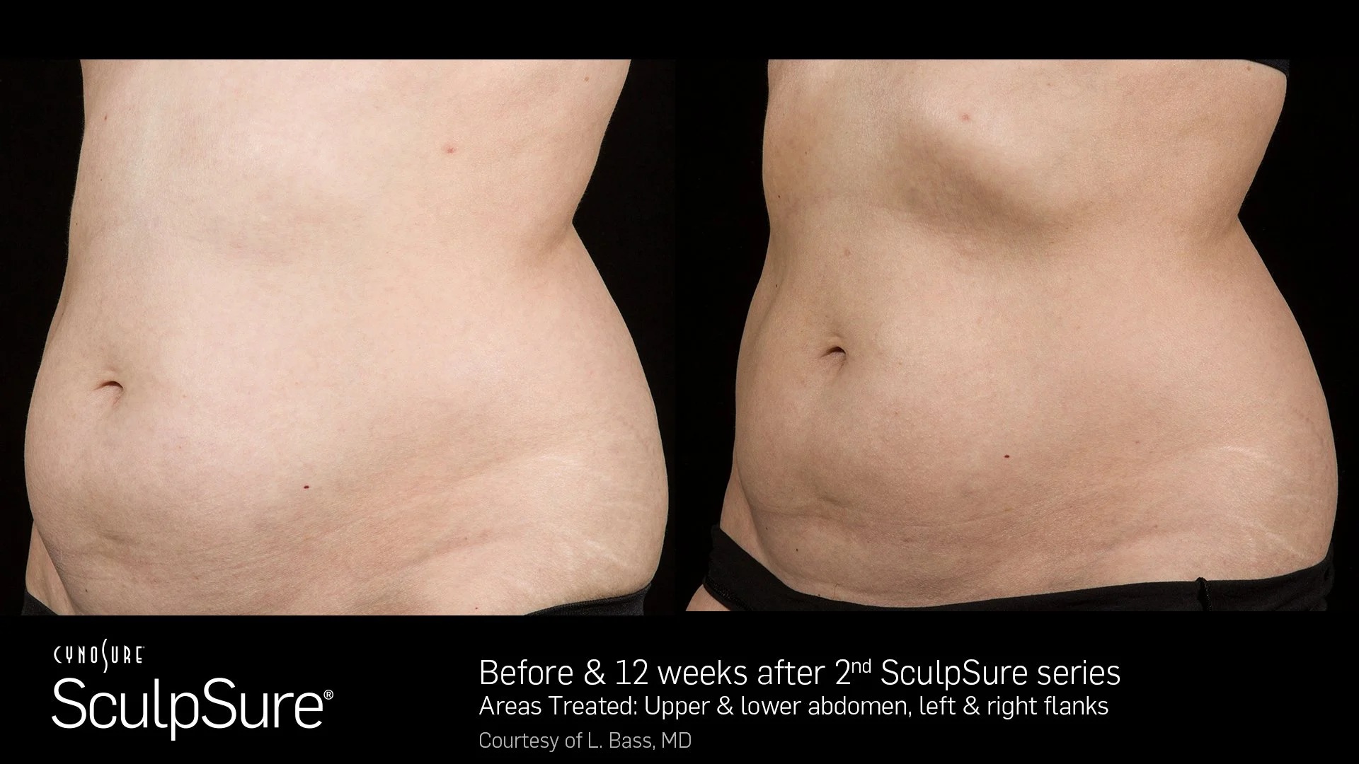 BA_SculpSure_L.Bass_Core_12wks_2-Tx_04.jpg