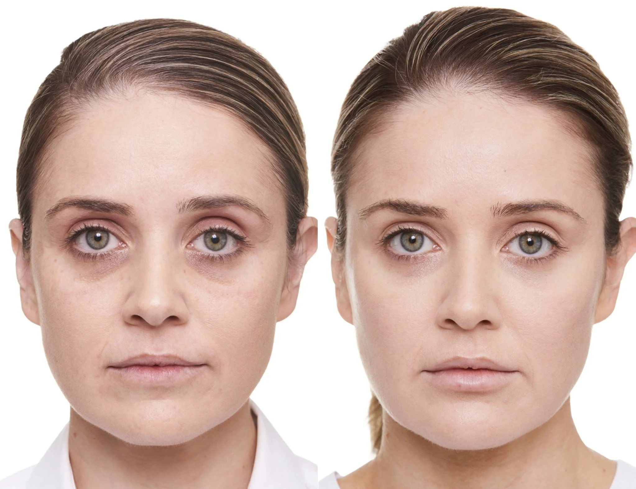 Cheek, Tear Trough and Lips.jpg