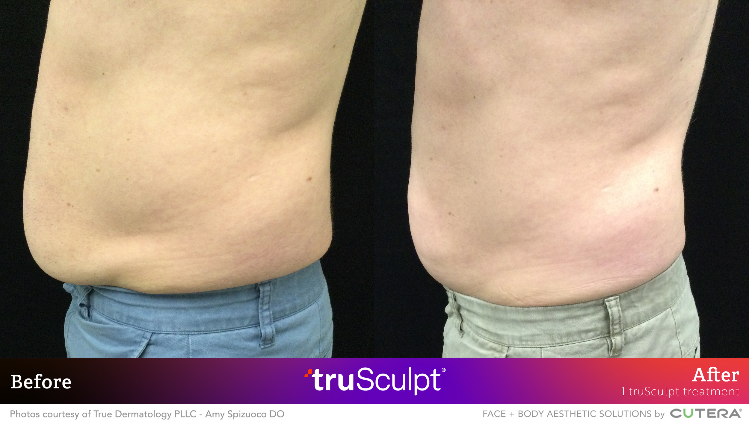 05_truSculpt ID_B&A_True Dermatology.png