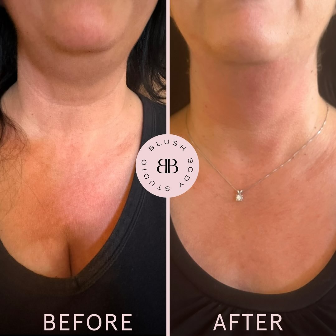 Our clients before and after 😍 Cryo T-Shock Facial Benefits: 
✔️ Reduction of fine lines and wrinkles 
✔️ Enhanced collagen production 
✔️ Facial contouring 
✔️ Improved skin tone and texture 
✔️ Minimization of blemishes