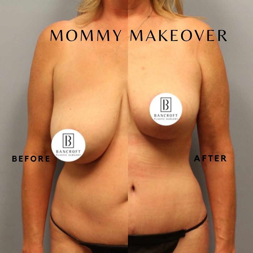 Another summer-ready Mommy Makeover!

#mommymakeover  #tummytucks  #breastlife  #mastopexy #liposuction #plasticsurgery #houstonplasticsurgery #houstonplasticsurgeons #sugarlandplasticsurgery #sugarlandplasticsurgeon #thebestsurgeon #bancroftplastics