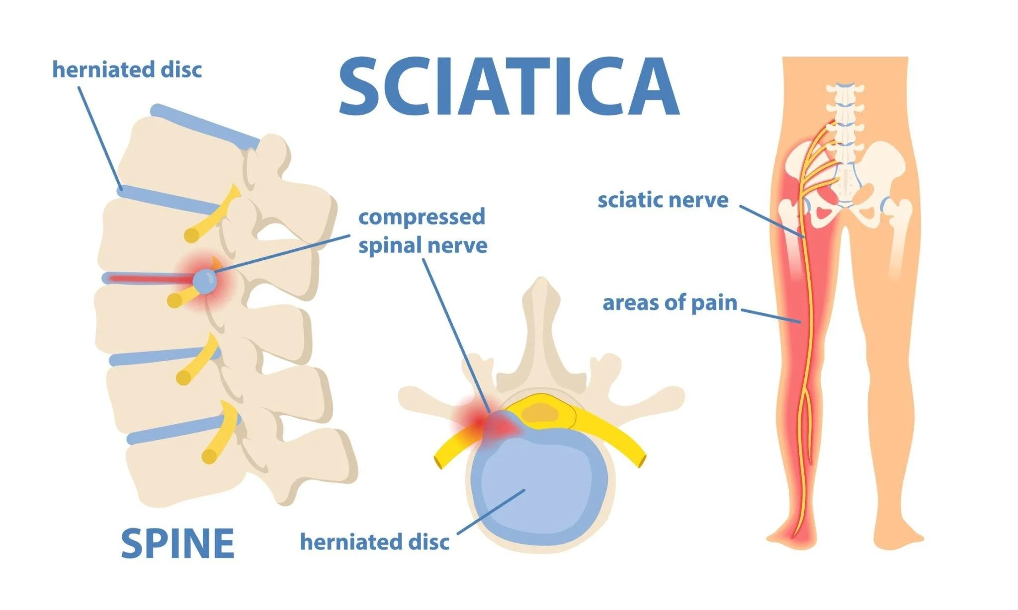 Sciatica Pain: 8 Poses to Try for Relief &amp; Prevention