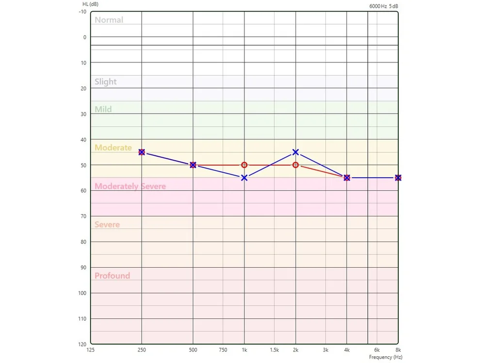 Understanding Your Hearing Test — Professional Audiologist in ...