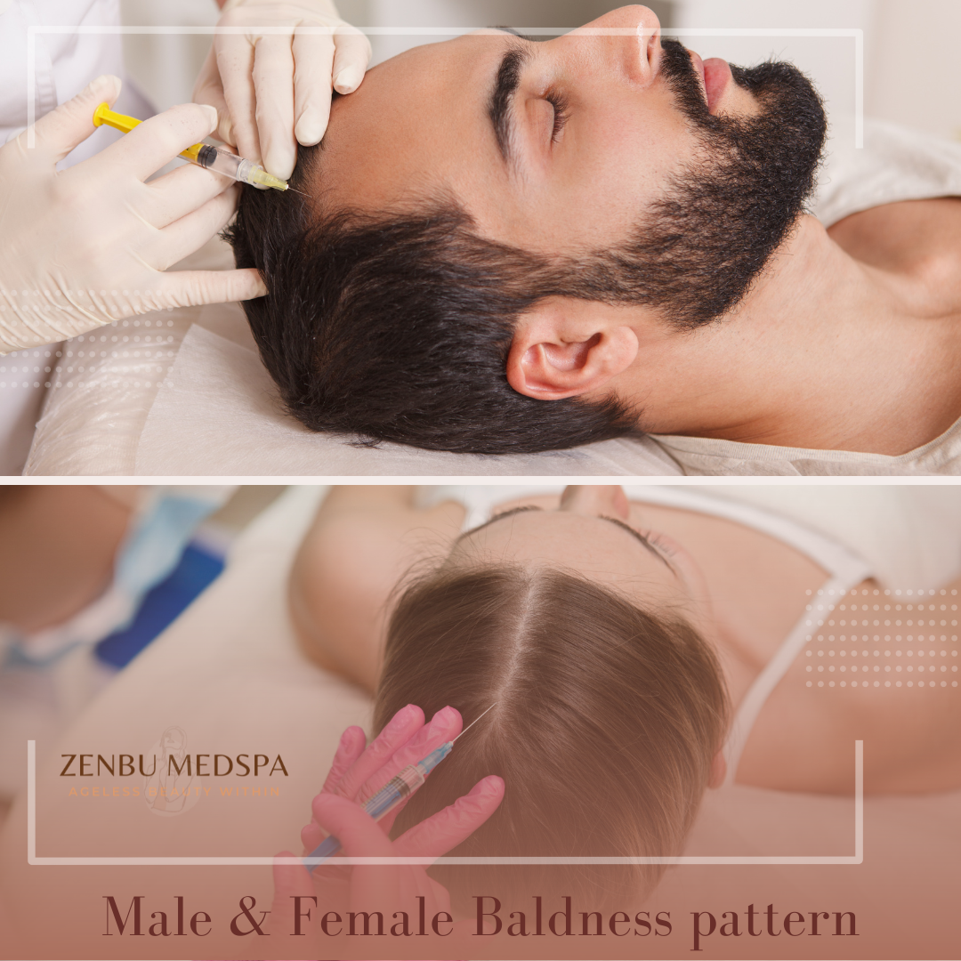 zenbu-baldness (1).png