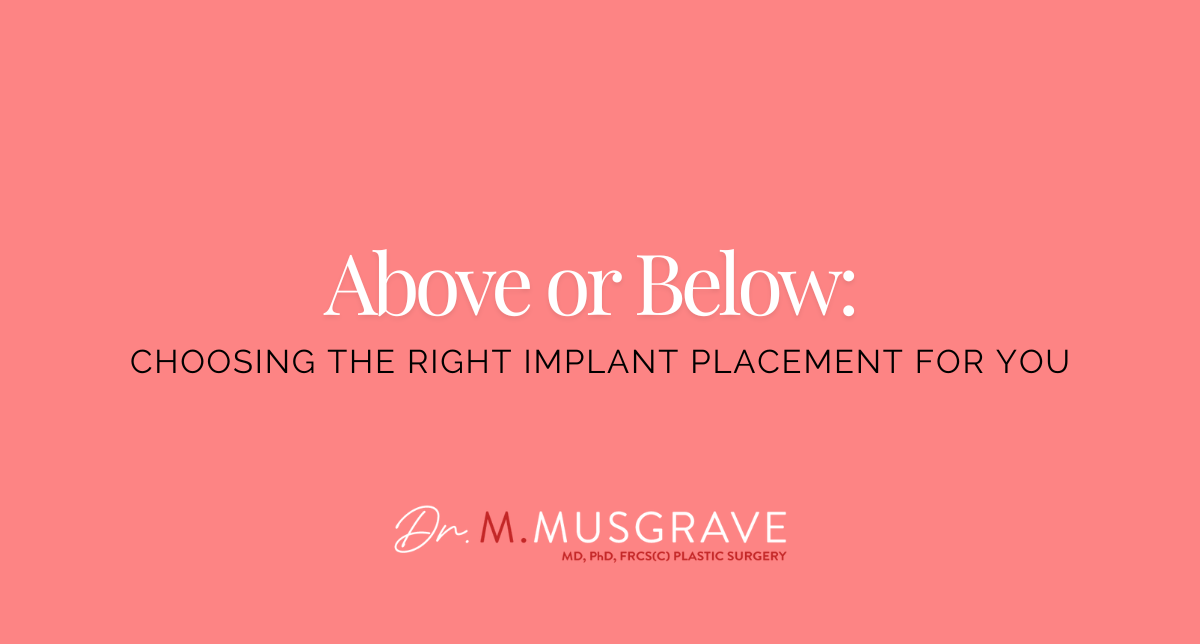 Above or Below: Choosing the Right Implant Placement for You
