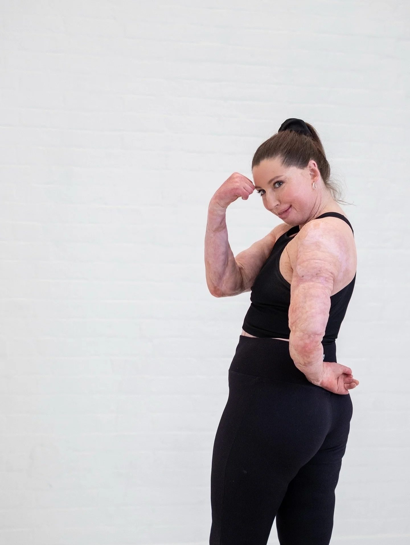 National Burns Awareness Day

Today, I want to shine a light on someone truly remarkable and one of my amazing clients - @catrinpugh 🤍

Catrin is a speaker, model, physiotherapist, and burns survivor who has faced challenges that most of us could ne