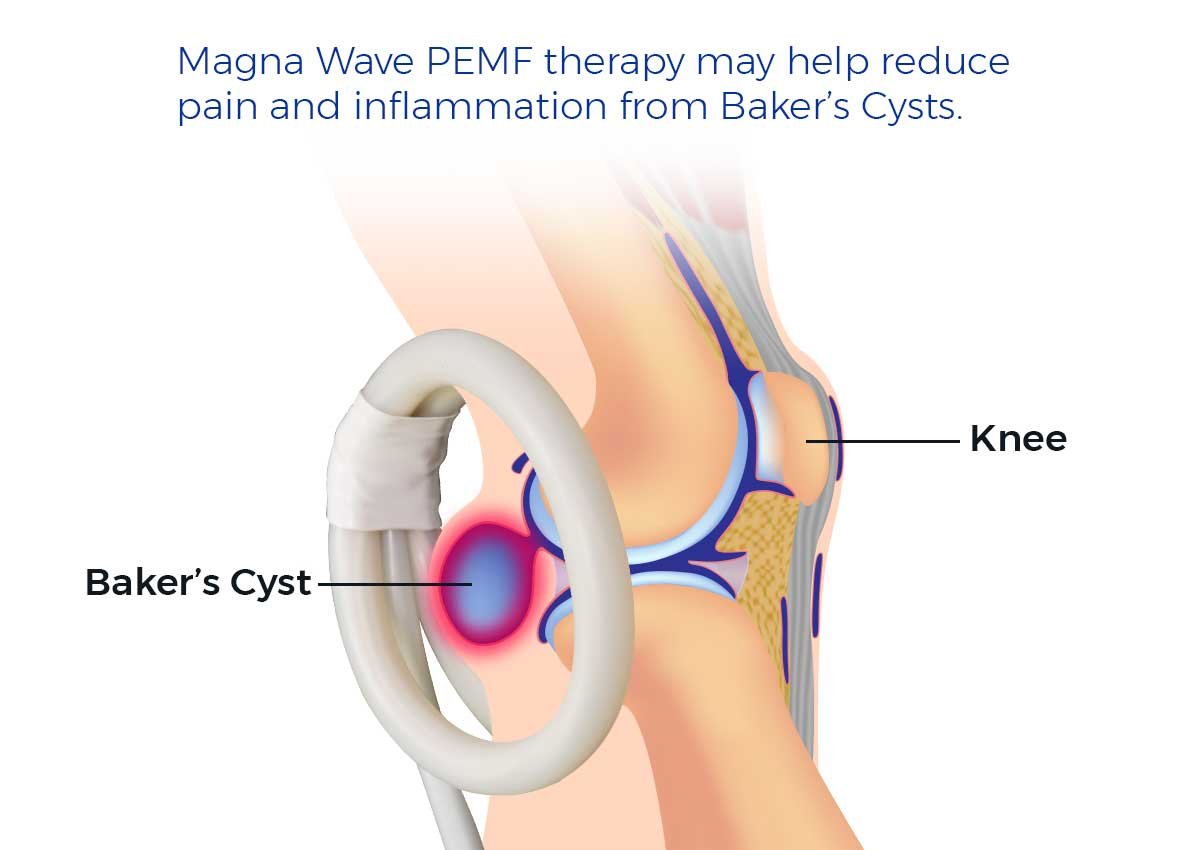 magna-wave-PEMF-Therapy-After-Surgery-Knee-Replacement-bakers-cyst.jpg