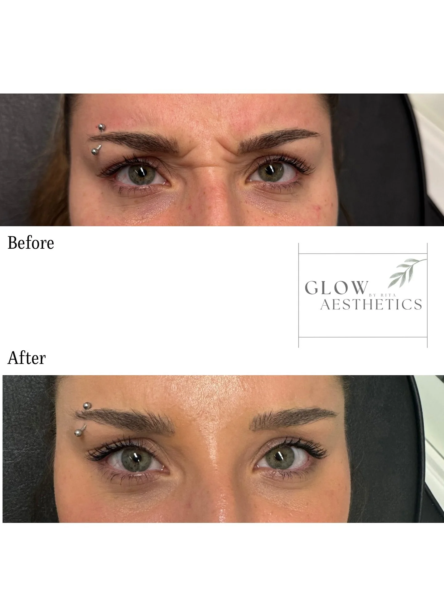 Reason #1000 why neuromodulators have my whole heart. ✨

#injector #aesthetics #medispa #medicalaesthetics 

📞 587-783-1252
👩&zwj;💻 www.glowbyrita.com