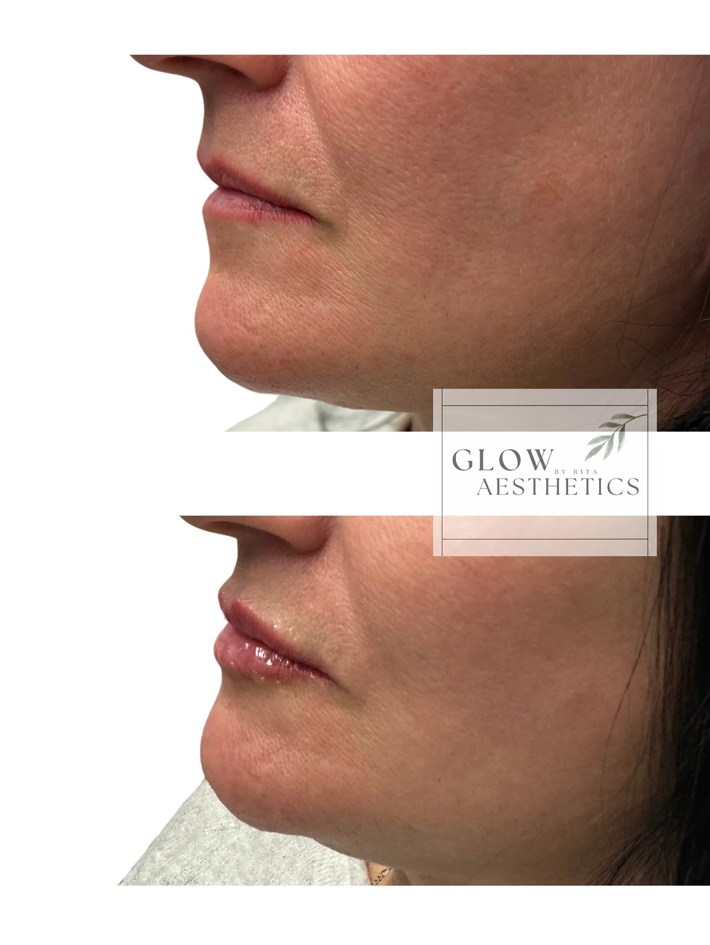 Subtle. Soft. Stunning. 💋 

Natural enhancement = your lips, but glowier.

1/2 syringe was used to create this gorgeous, hydrated look 💉

👩&zwj;💻 www.glowbyrita.com
📞 587-783-1252

#lipgoals #naturalresults