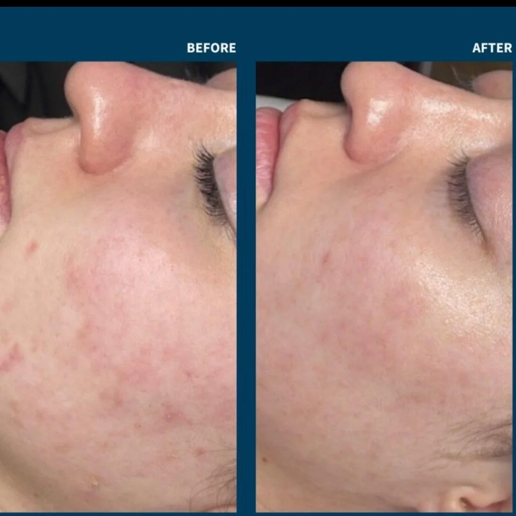 April = Microneedling Month at Glow 🤍✨

if your skin is feeling dull, textured, or just needs a reset after winter &mdash; this is it 🌸

we&rsquo;re dropping our microneedling specials on Monday&hellip; and trust me, you&rsquo;re going to want in

