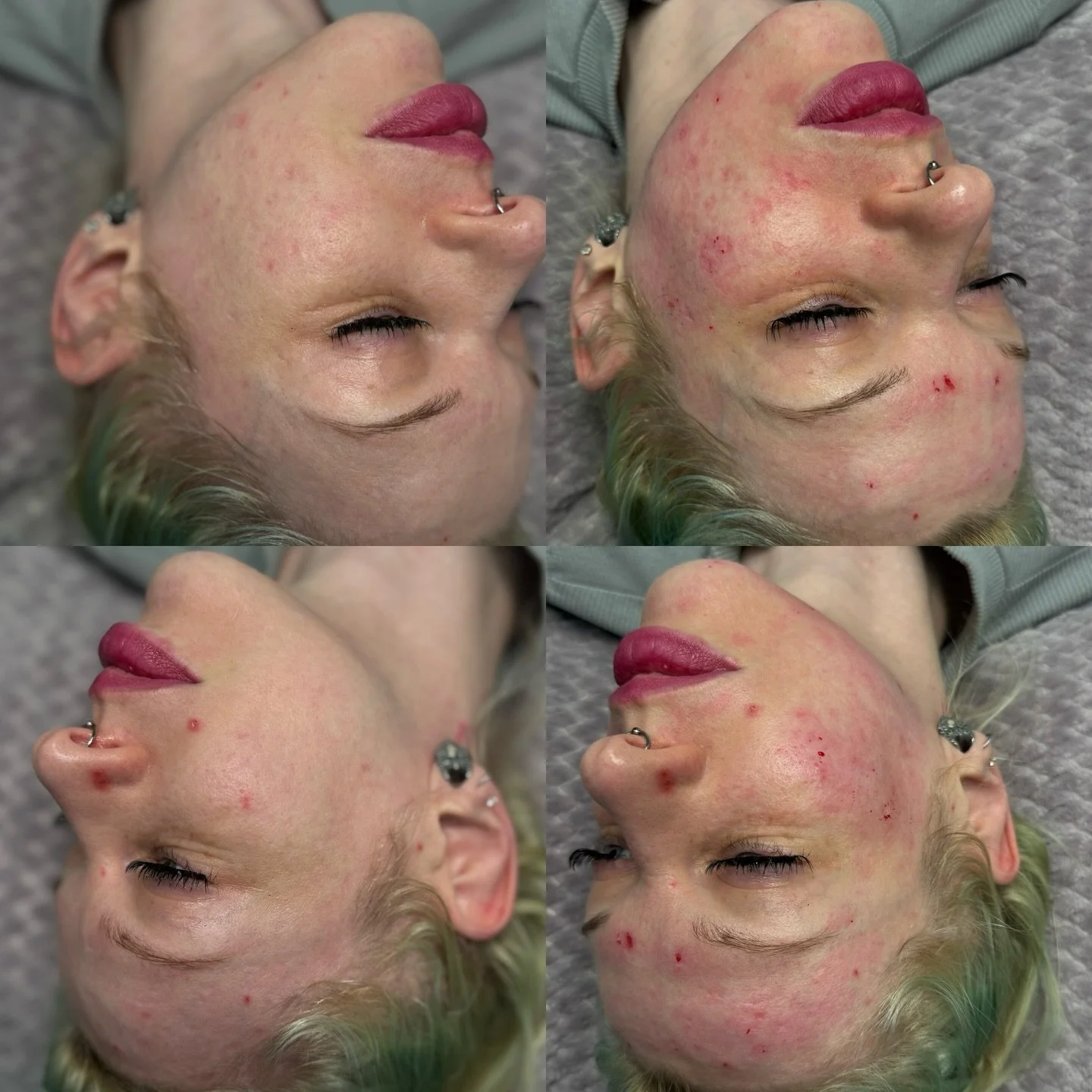 Microneedling treatments for acne scarring ✨

If texture and scarring are your concern&hellip; this is one of the best places to start.

Post treatment redness lasts ~24 hours. 

Microneedling sale is on until the end of the month! Book your appointm