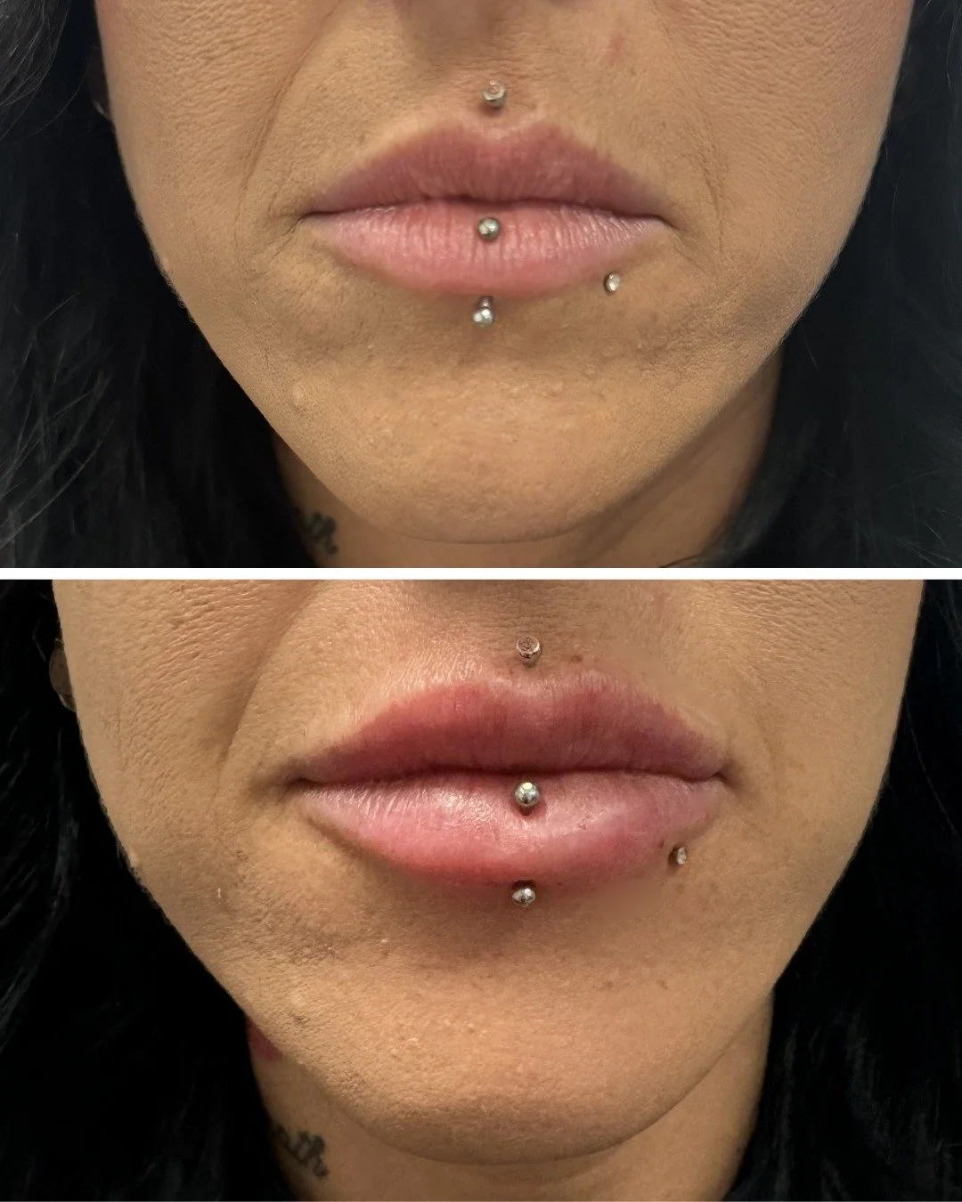 Fine lines? Gone.
Dry lips? Hydrated.

These volumous lips are ready for summer with just 1 syringe of filler 🤍☀

Interested in Booking?? 
▪Booking Link in Bio
▪DM
▪587-783-1252

📍5126 50St Barrhead AB