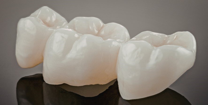 Polished white same day ceramic crowns