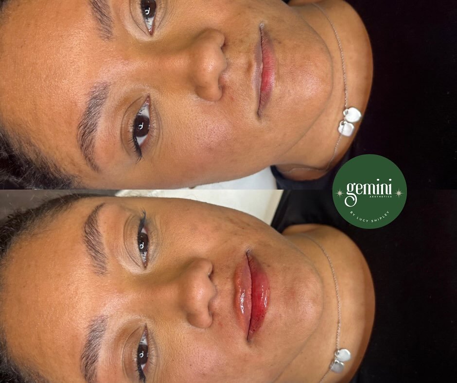 Happy Saturday gorgeous lot! Just me or does it actually feel like spring today? 🌷 bout time too. 

This utter babe came to me for the first time wanting to enhance her already gorgeous natural shape. Like a lot of you she really wanted to avoid the