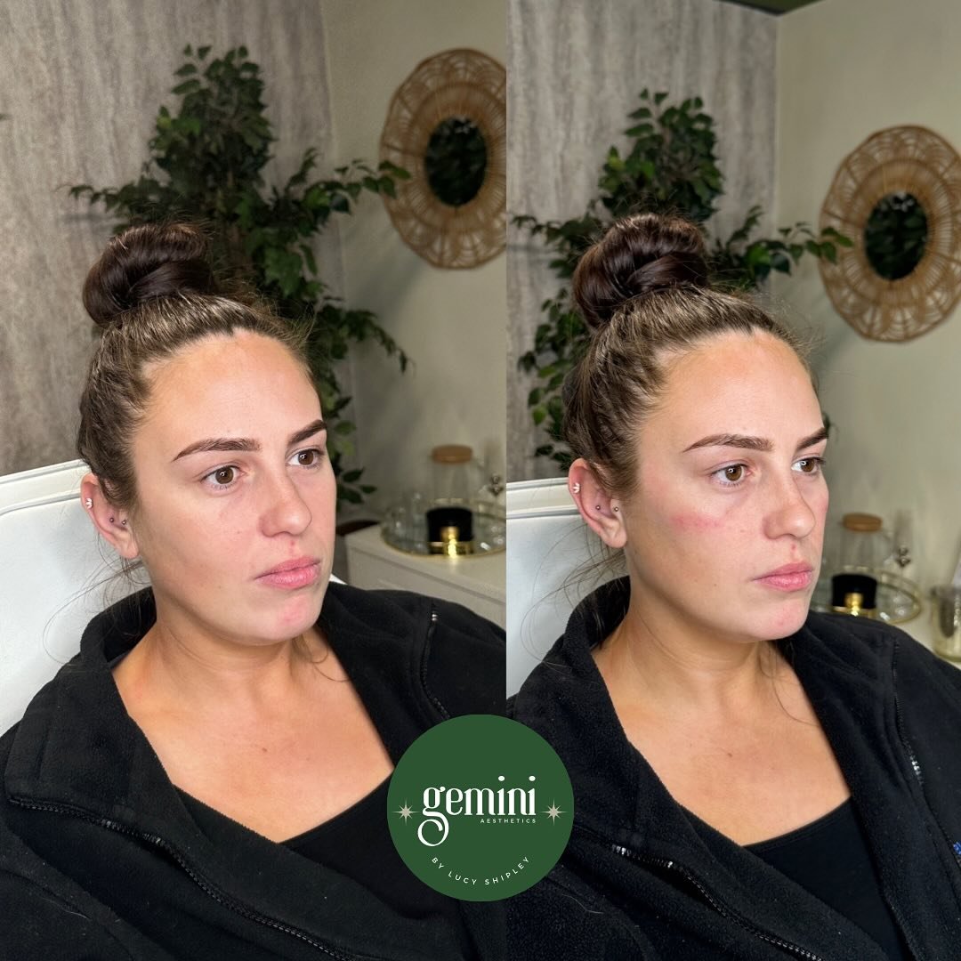 Getting this treasure wedding ready 🥹

We&rsquo;ve treated the cheeks with small amount of dermal filler. My client will likely need a further session prior to her big day 💒