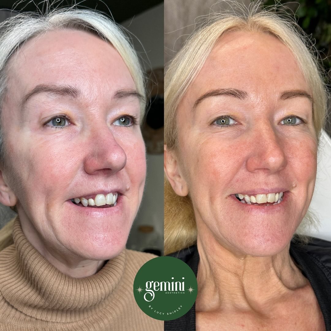 This one made us a little emotional 🥹

My lovely client came to me for a touch of cheek filler, gummy smile treatment and a lip flip and this is her results 2 weeks later. She has been conscious about her top lip &ldquo;disappearing&rdquo; and feeli