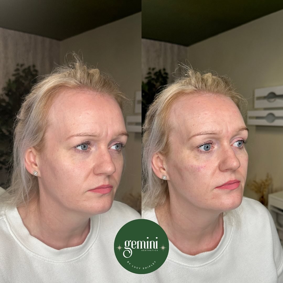 I&rsquo;m going to start calling this the &ldquo;wake me up&rdquo; treatment. 9 out of 10 times I hand the mirror over and my client says something along the lines of: &ldquo;God, I look like I&rsquo;ve slept&rdquo; 😆

I love restoring the mid face,