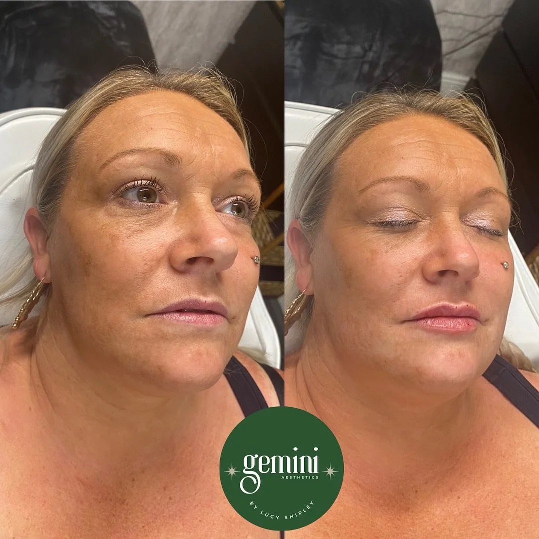 Side-by-side before and after photos of a woman with a relaxed expression, showing improvements in skin texture and appearance, with the logo of Gemini Aesthetics at the bottom.