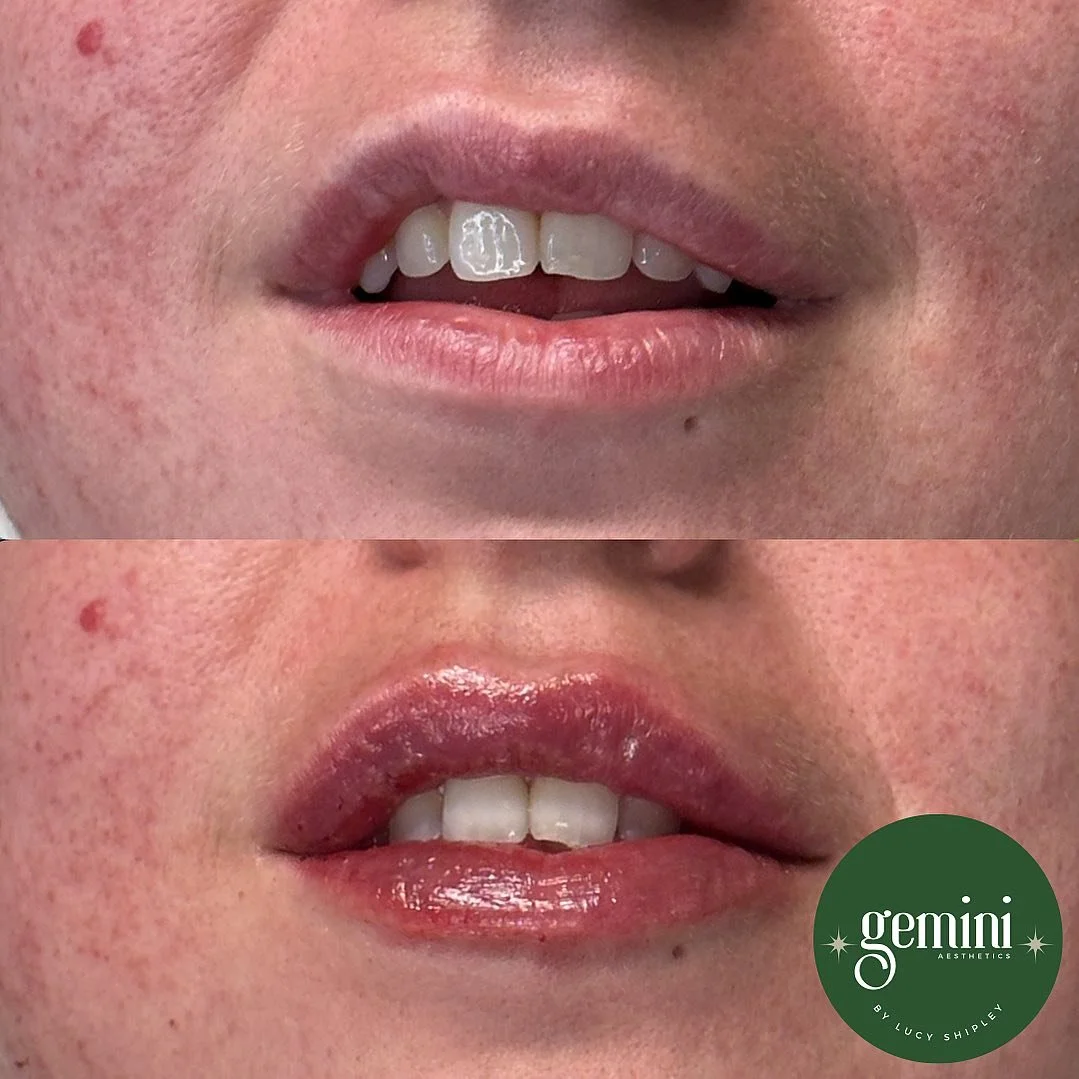 Close-up of a person's lips and teeth before and after a cosmetic lip makeover, with the Gemini Aesthetics logo in the bottom right corner.
