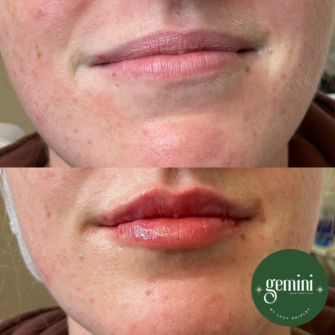 Close-up of a person's lips before and after cosmetic lip treatment, showing smoother, fuller lips in the after image, with a green 'Gemini Aesthetics' logo in the bottom right corner.