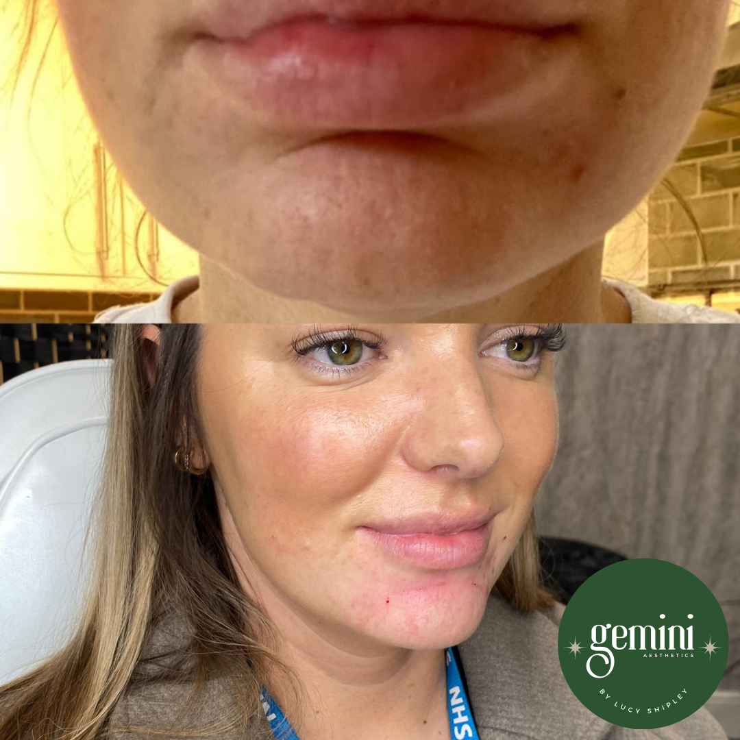 A before and after photo of a woman who has undergone cosmetic treatment. The top shows her lips and bottom face with uneven skin texture, while the bottom shows smoother, clearer skin with enhanced facial features. The image includes a green circle 
