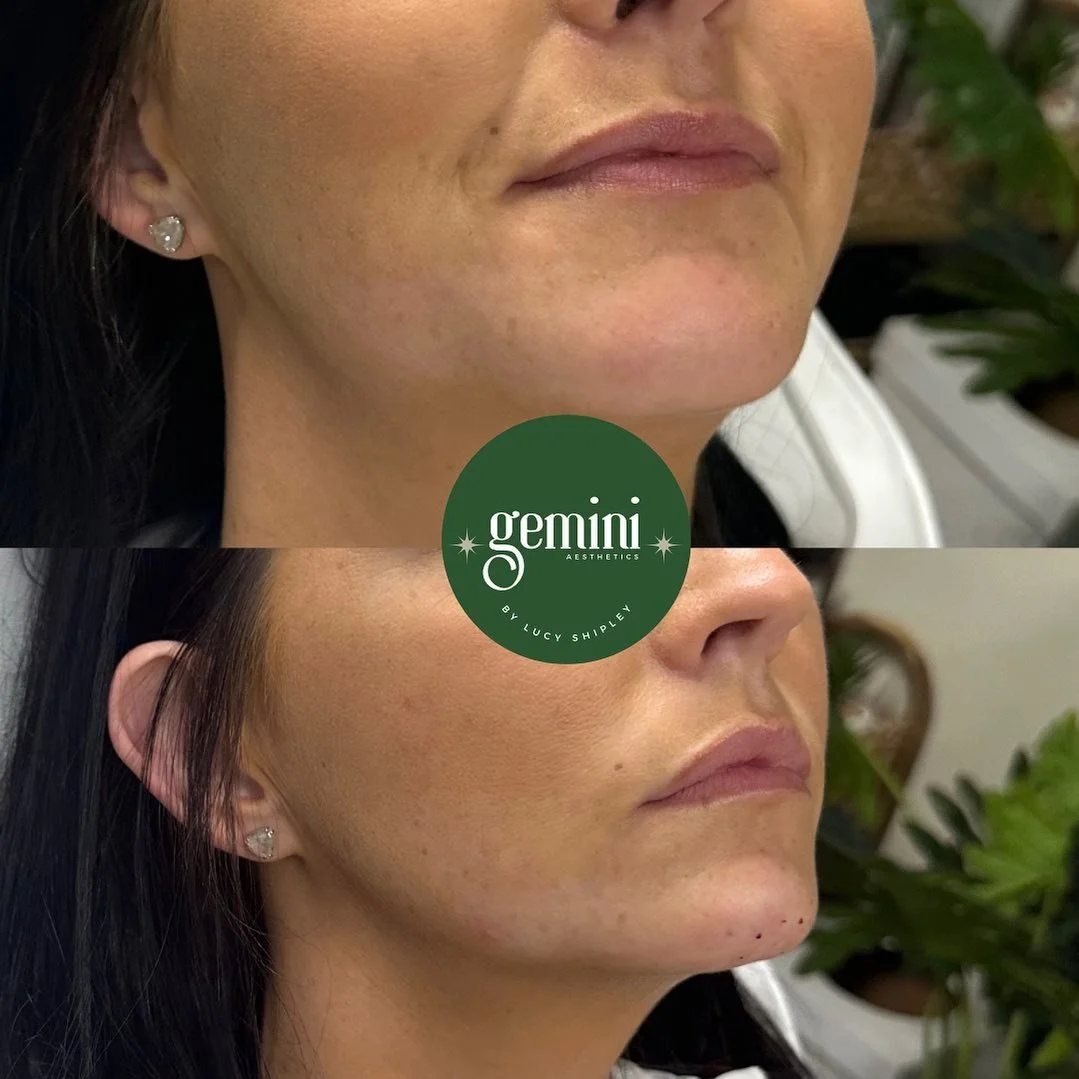 Before and after photos showing a woman's jawline and chin area, indicating a cosmetic improvement for a more defined look, with the logo of Gemini Aesthetics by Lucy Shipley in the center.