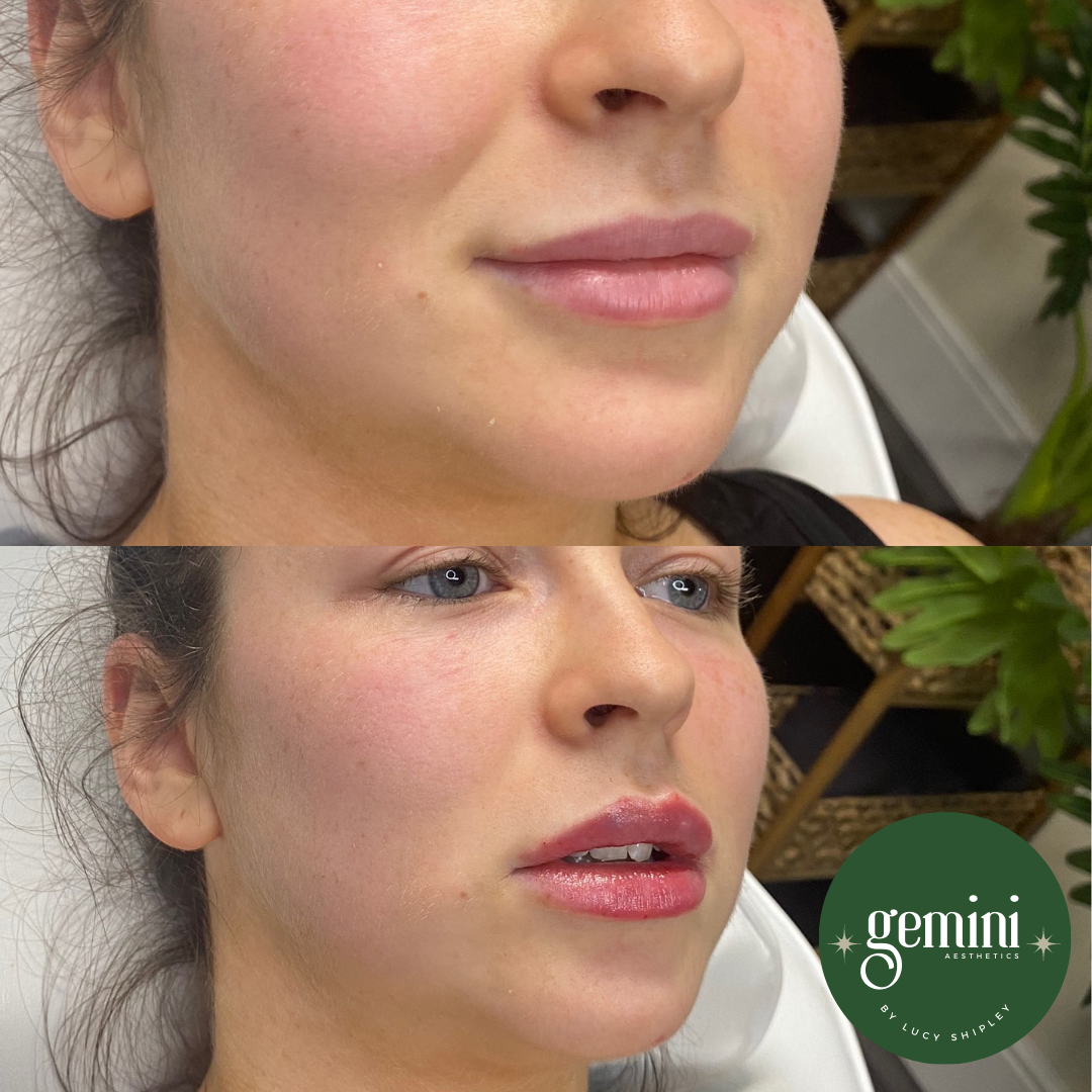 Comparison of a woman's face before and after cosmetic enhancement, showing improved lip fullness and gloss in the after photo, with a Gemini Aesthetics logo in the bottom right corner.