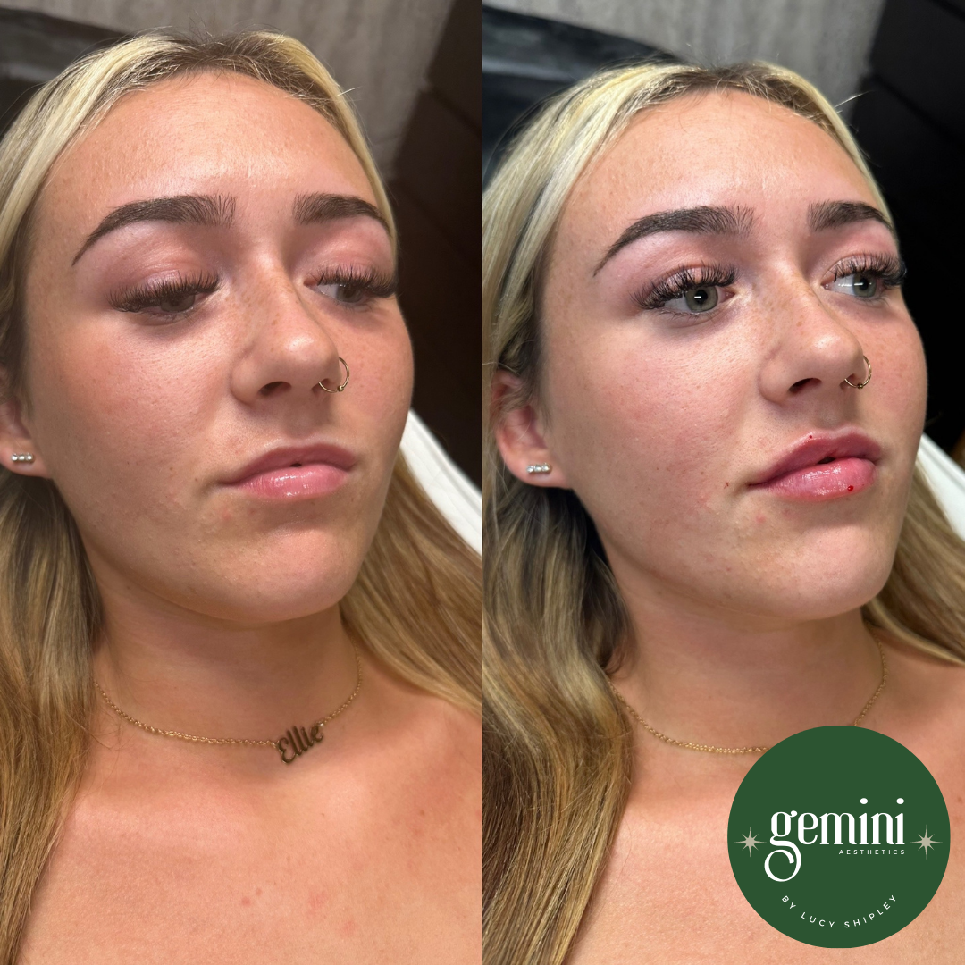 Side-by-side close-up photos of a young woman before and after cosmetic skin treatment, showing improved skin texture and clarity. The woman has blonde hair, light skin, and is wearing a gold necklace with the name Elle, and a small nose ring.