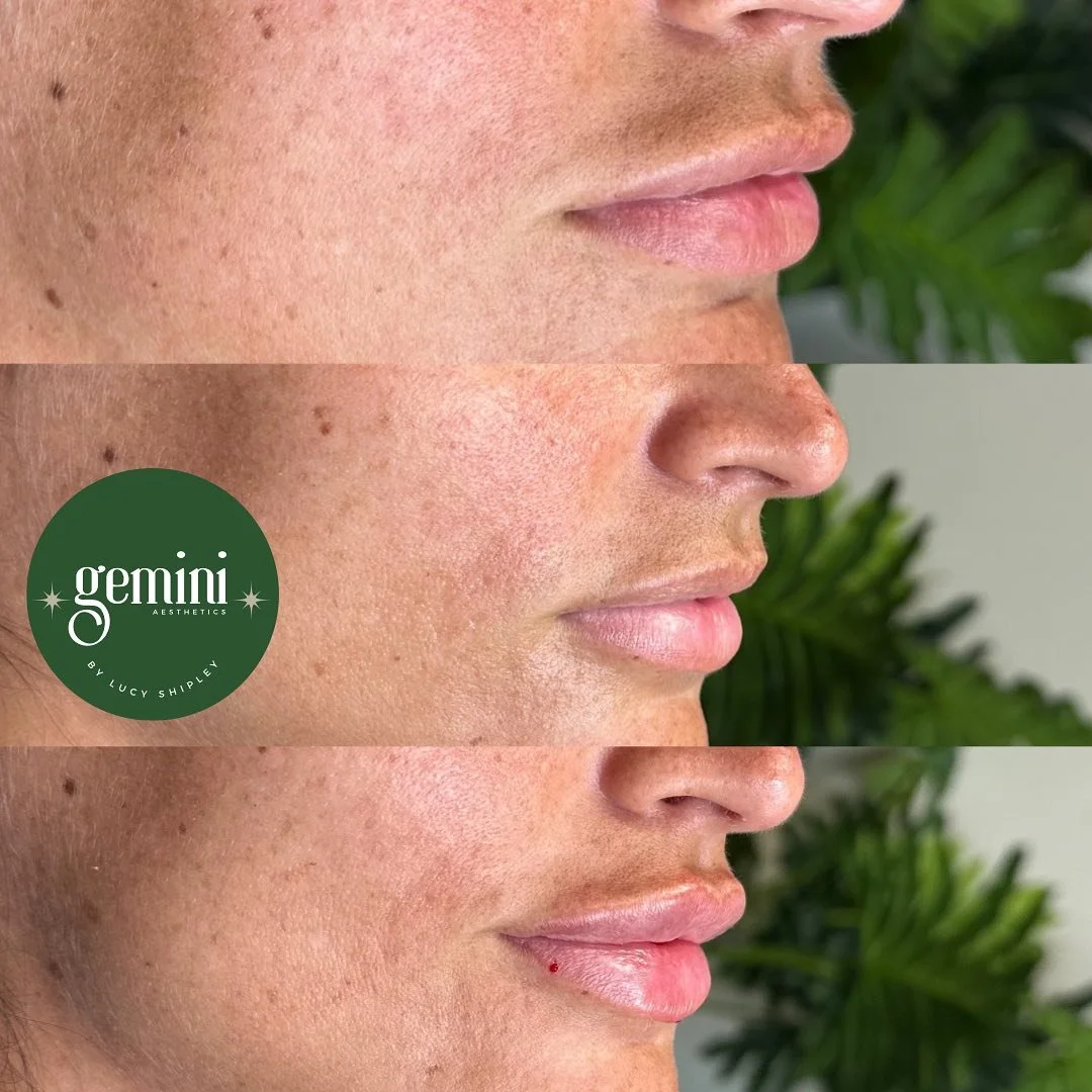 Three side-profile close-up images of a woman's face showing a progression of skin improvements, focusing on cheek and lip areas, with a green leafy background. The middle image has a green logo that says 'gemini AESTHETICS BY LUCY SHIPLEY'.