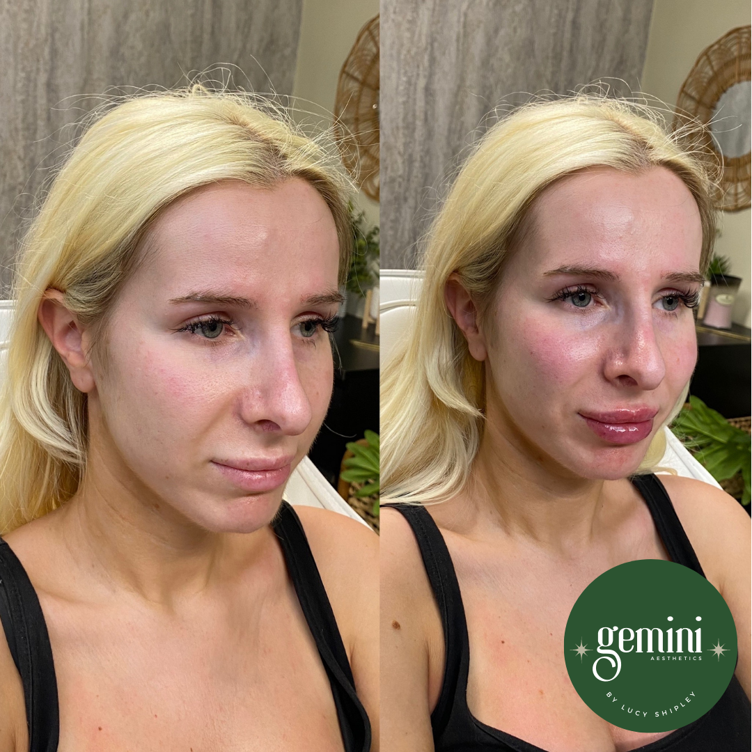 Comparison of a woman's face before and after receiving an aesthetic treatment, with a logo for Gemini Aesthetics by Lucy Shipley in the bottom right corner.