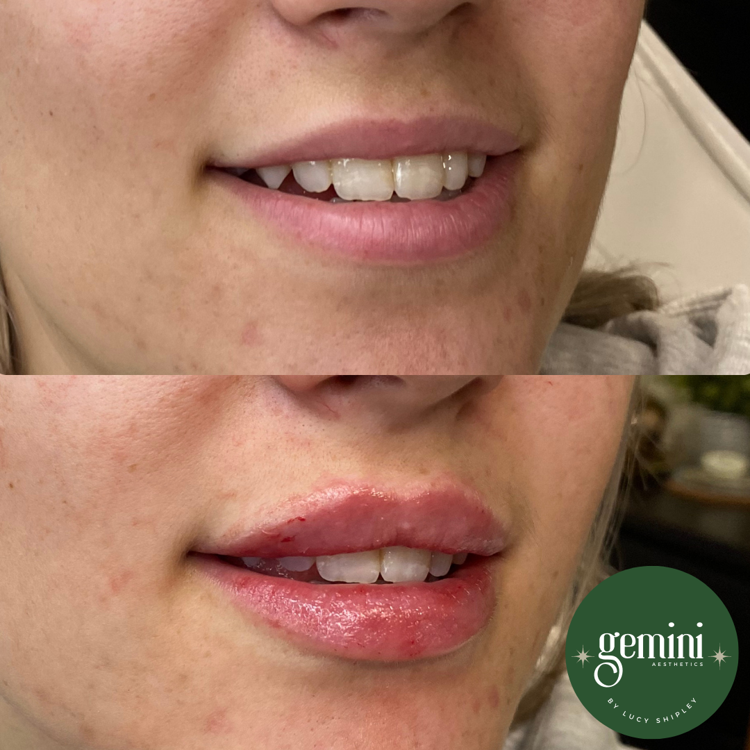 A side-by-side comparison of a woman's lips before and after lip enhancement treatment. The top image shows natural lips with a slight gap between the front teeth, and the bottom image shows fuller, glossy lips with a small cut on the lower lip. A gr