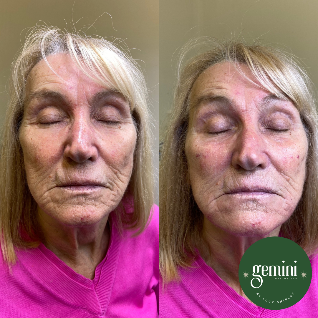 Close-up of an elderly woman with blonde hair, showing before and after facial skin treatment results, wearing a pink top, with closed eyes.