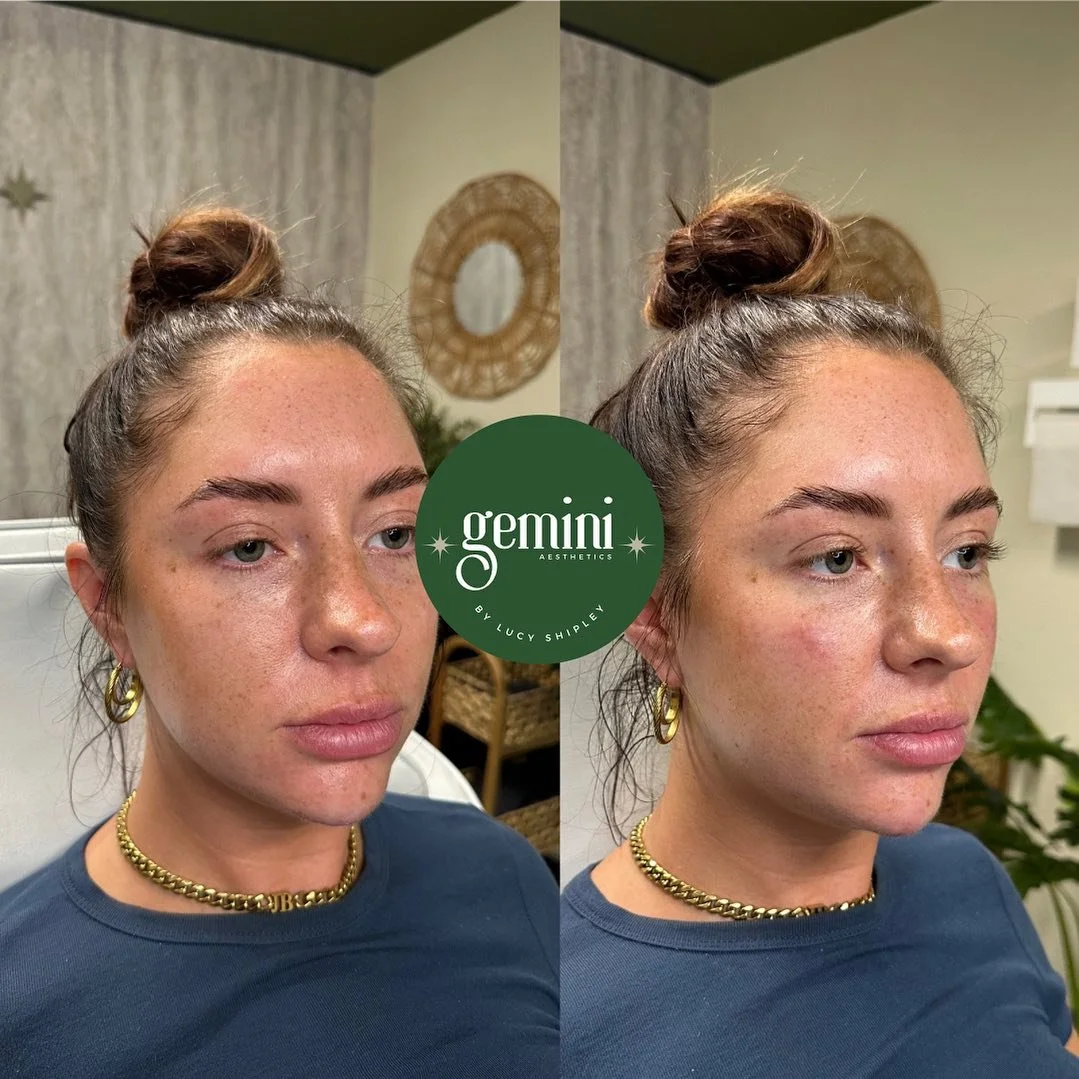 Side-by-side comparison of a woman's face before and after aesthetic treatment, showing improved skin texture, reduced redness, and a more even complexion, with a circular Gemini Aesthetics logo overlay.