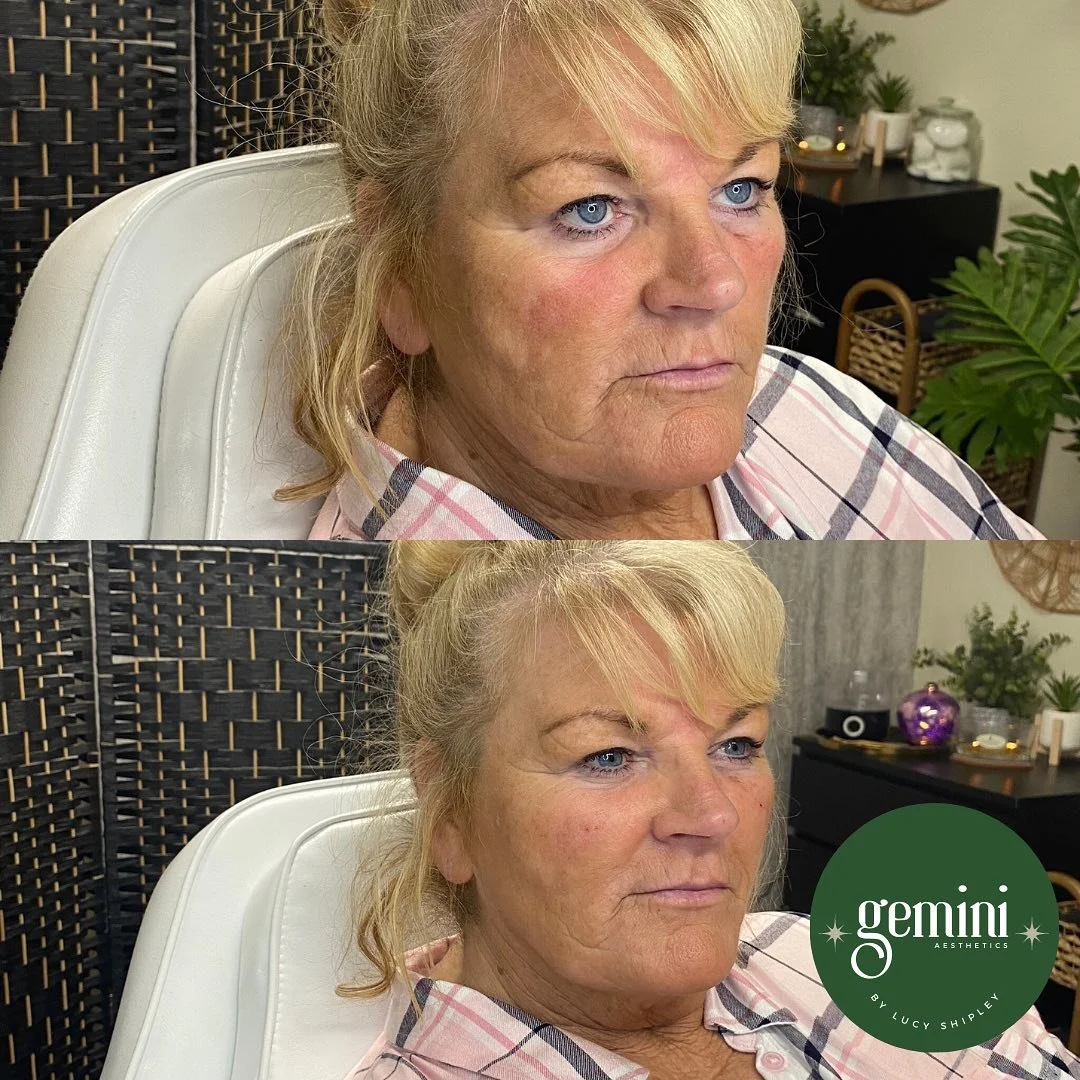 Side-by-side comparison of a woman before and after a cosmetic treatment, showing improved skin texture and tone, with a logo for Gemini Aesthetics in the second image.